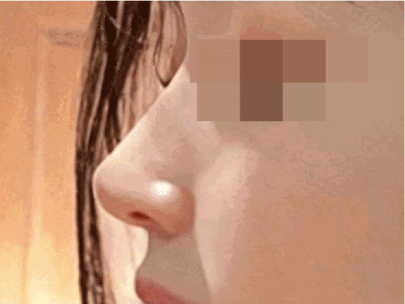 自体软骨隆鼻项目示意